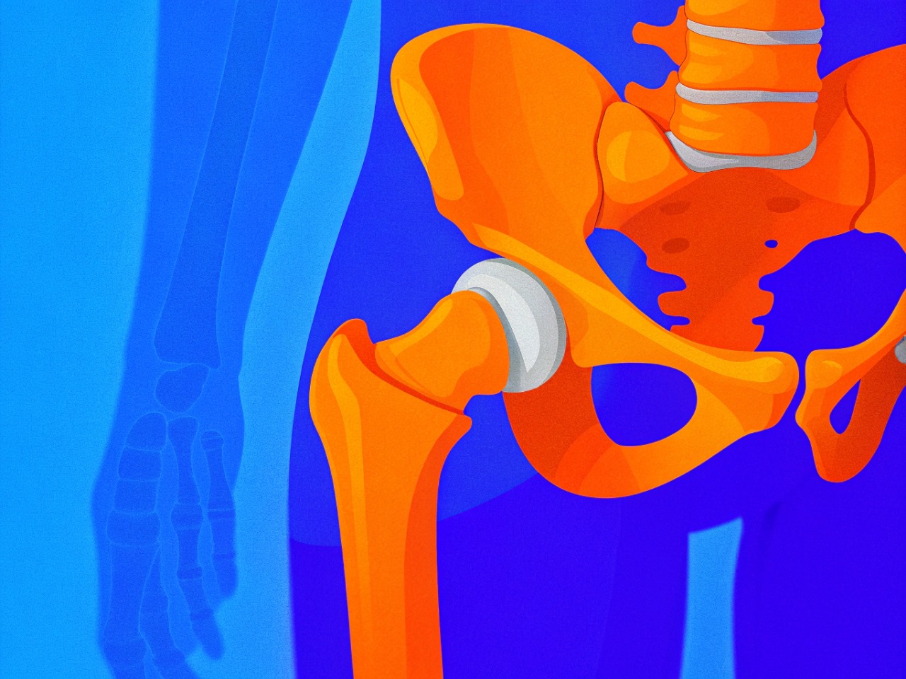 Обзор Российских рекомендаций по микробиологической диагностике биоматериалов при имплантат-ассоциированных инфекциях 2025